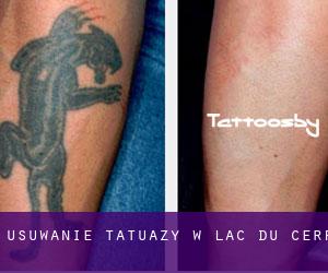 Usuwanie tatuaży w Lac-du-Cerf
