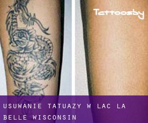 Usuwanie tatuaży w Lac La Belle (Wisconsin)