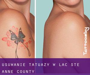 Usuwanie tatuaży w Lac Ste. Anne County