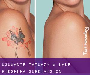 Usuwanie tatuaży w Lake Ridgelea Subdivision