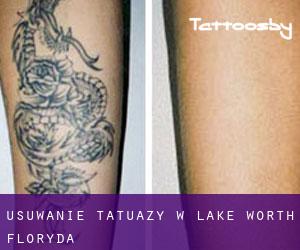 Usuwanie tatuaży w Lake Worth (Floryda)