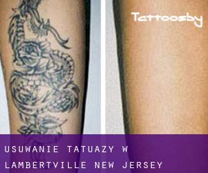 Usuwanie tatuaży w Lambertville (New Jersey)