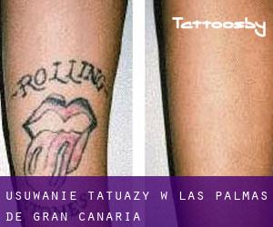 Usuwanie tatuaży w Las Palmas de Gran Canaria