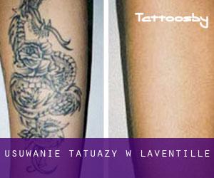 Usuwanie tatuaży w Laventille