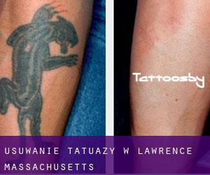 Usuwanie tatuaży w Lawrence (Massachusetts)