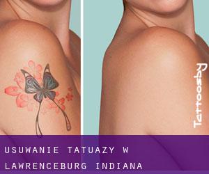 Usuwanie tatuaży w Lawrenceburg (Indiana)