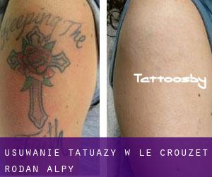 Usuwanie tatuaży w Le Crouzet (Rodan-Alpy)
