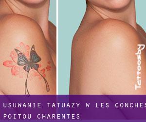 Usuwanie tatuaży w Les Conches (Poitou-Charentes)