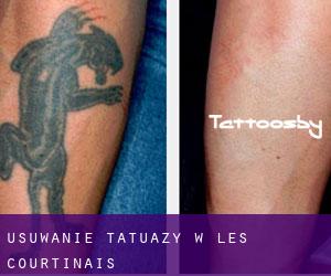 Usuwanie tatuaży w Les Courtinais