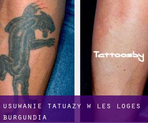 Usuwanie tatuaży w Les Loges (Burgundia)