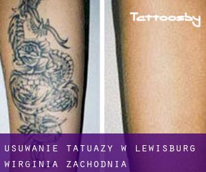 Usuwanie tatuaży w Lewisburg (Wirginia Zachodnia)
