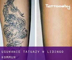 Usuwanie tatuaży w Lidingö Kommun