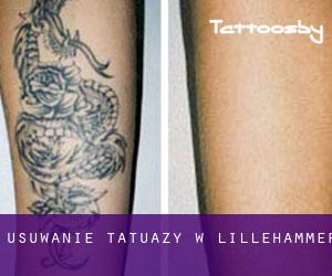 Usuwanie tatuaży w Lillehammer