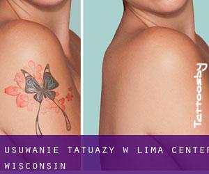 Usuwanie tatuaży w Lima Center (Wisconsin)