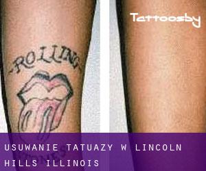 Usuwanie tatuaży w Lincoln Hills (Illinois)