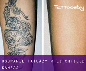 Usuwanie tatuaży w Litchfield (Kansas)