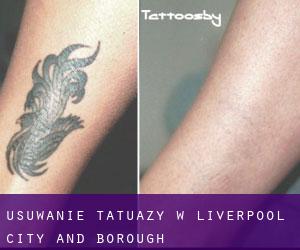 Usuwanie tatuaży w Liverpool (City and Borough)