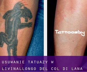 Usuwanie tatuaży w Livinallongo del Col di Lana