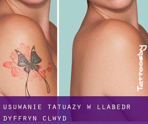 Usuwanie tatuaży w Llabedr-Dyffryn-Clwyd