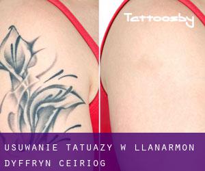Usuwanie tatuaży w Llanarmon Dyffryn-Ceiriog