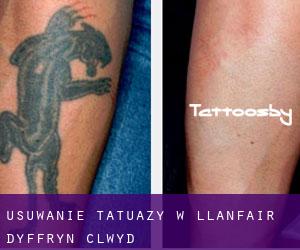 Usuwanie tatuaży w Llanfair-Dyffryn-Clwyd