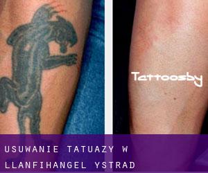 Usuwanie tatuaży w Llanfihangel-Ystrad