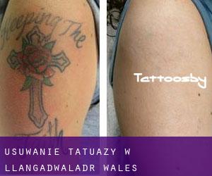 Usuwanie tatuaży w Llangadwaladr (Wales)