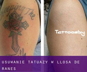 Usuwanie tatuaży w Llosa de Ranes
