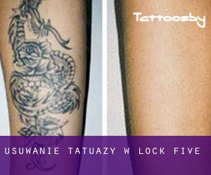 Usuwanie tatuaży w Lock Five