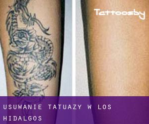 Usuwanie tatuaży w Los Hidalgos