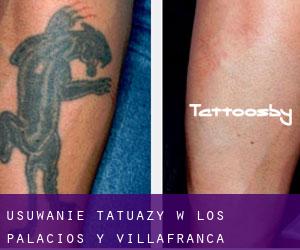 Usuwanie tatuaży w Los Palacios y Villafranca
