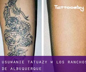 Usuwanie tatuaży w Los Ranchos de Albuquerque