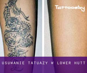 Usuwanie tatuaży w Lower Hutt