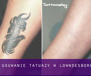 Usuwanie tatuaży w Lowndesboro