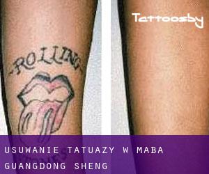 Usuwanie tatuaży w Maba (Guangdong Sheng)