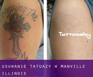 Usuwanie tatuaży w Manville (Illinois)