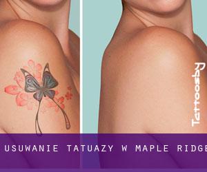 Usuwanie tatuaży w Maple Ridge