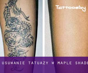 Usuwanie tatuaży w Maple Shade
