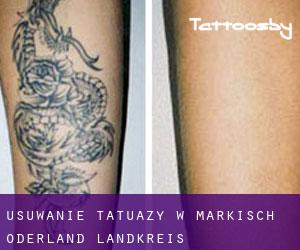 Usuwanie tatuaży w Märkisch-Oderland Landkreis