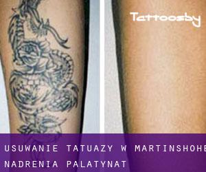 Usuwanie tatuaży w Martinshöhe (Nadrenia-Palatynat)
