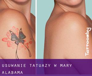 Usuwanie tatuaży w Mary (Alabama)