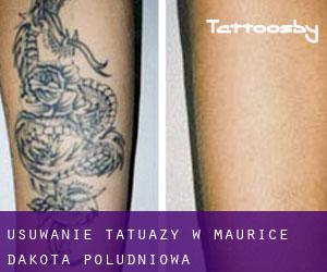 Usuwanie tatuaży w Maurice (Dakota Południowa)