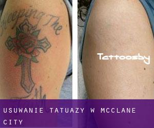 Usuwanie tatuaży w McClane City