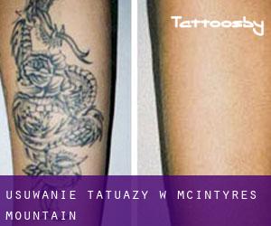 Usuwanie tatuaży w McIntyres Mountain