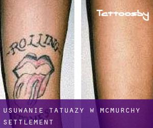 Usuwanie tatuaży w McMurchy Settlement