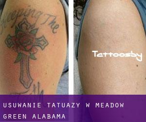 Usuwanie tatuaży w Meadow Green (Alabama)