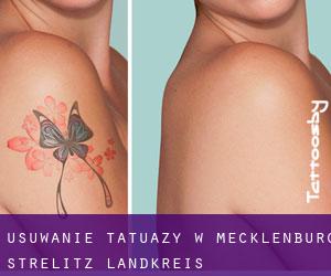 Usuwanie tatuaży w Mecklenburg-Strelitz Landkreis
