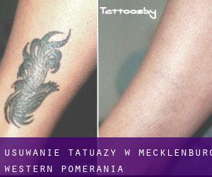Usuwanie tatuaży w Mecklenburg-Western Pomerania