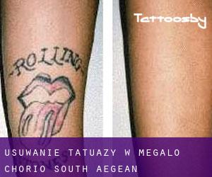 Usuwanie tatuaży w Megálo Chorió (South Aegean)