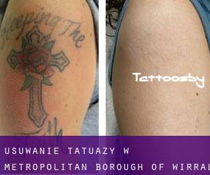 Usuwanie tatuaży w Metropolitan Borough of Wirral
